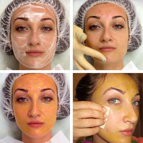 Lợi ích và tác hại của việc lột mặt: hóa chất, axit trái cây, glycolic, phần cứng, retinol, Jessner, axit succinic, với canxi