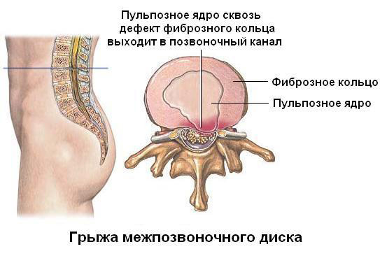 Bài tập cho cột sống với bóng theo Bubnovsky, với bệnh thoái hóa xương và thoát vị cột sống thắt lưng