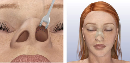 Nâng mũi không phẫu thuật, đóng, mở, tái tạo, tiêm, phục hồi chức năng