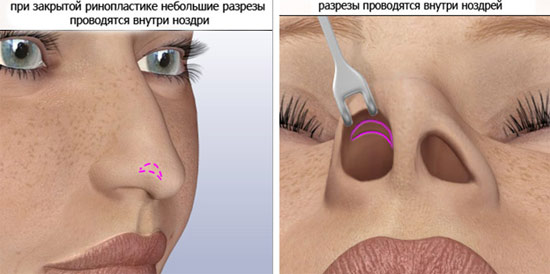 Nâng mũi không phẫu thuật, đóng, mở, tái tạo, tiêm, phục hồi chức năng
