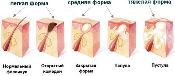 Антибиотици за акне на лицу: таблете, маст, крема, гел, ињекције