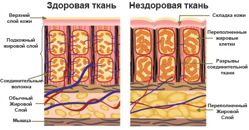 Како направити антицелулитну масажу себи код куће помоћу вакуумских конзерви, меда, стомака