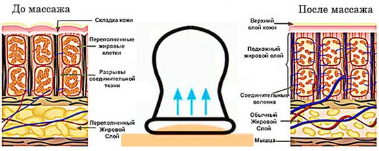 Како направити антицелулитну масажу себи код куће помоћу вакуумских конзерви, меда, стомака