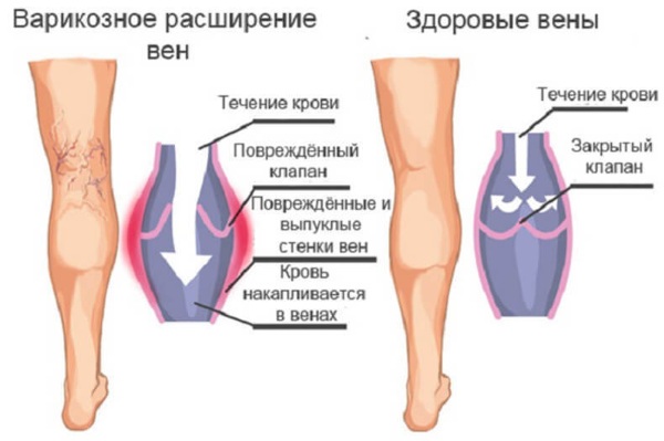 Burpee là một kỹ thuật thực hiện, nó là gì, làm như thế nào cho đúng. Các bài tập cho cô gái mới bắt đầu: làm khô và giảm cân điên cuồng