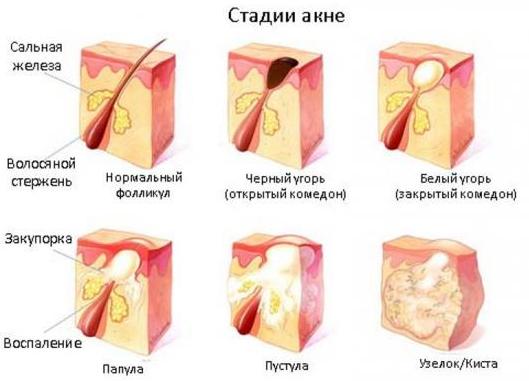 Người nói chuyện trị mụn. Công thức của bác sĩ da liễu với Levomycetin và axit Salicylic. Cách pha chế và sử dụng