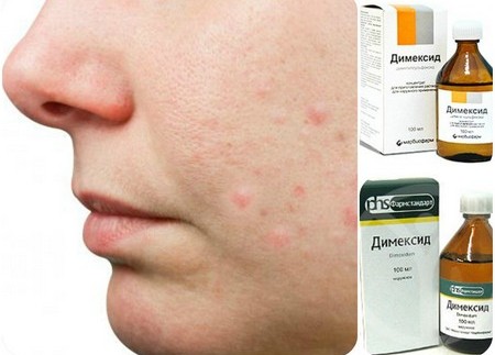 Người nói chuyện trị mụn. Công thức của bác sĩ da liễu với Levomycetin và axit Salicylic. Cách pha chế và sử dụng