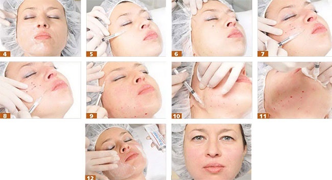 Chất làm đầy dựa trên axit hyaluronic. Tên, loại, hành động, hiệu ứng ứng dụng, giá cả và đánh giá