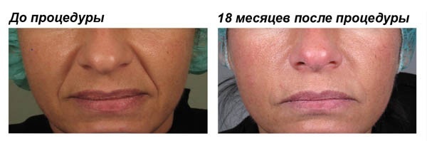 Chất làm đầy dựa trên axit hyaluronic. Tên, loại, hành động, hiệu ứng ứng dụng, giá cả và đánh giá