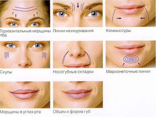 Chất làm đầy dựa trên axit hyaluronic. Tên, loại, hành động, hiệu ứng ứng dụng, giá cả và đánh giá