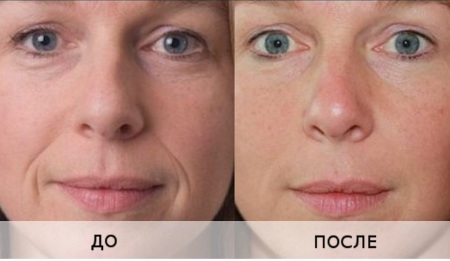 Chất làm đầy dựa trên axit hyaluronic. Tên, loại, hành động, hiệu ứng ứng dụng, giá cả và đánh giá