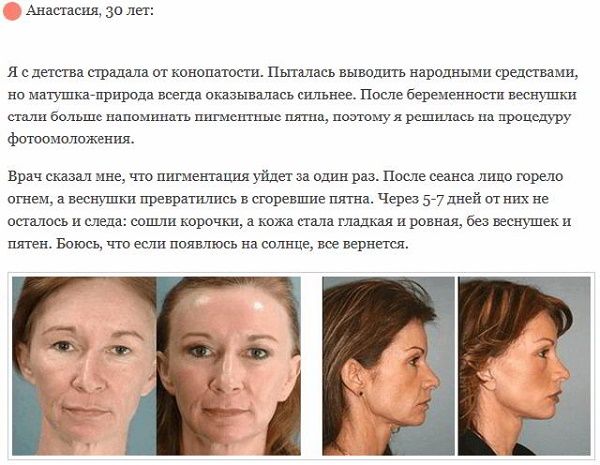 Trẻ hóa khuôn mặt - nó là gì, ưu và nhược điểm, trước và sau khi chụp ảnh, chỉ định và chống chỉ định