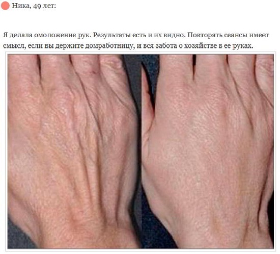 Trẻ hóa khuôn mặt - nó là gì, ưu và nhược điểm, trước và sau khi chụp ảnh, chỉ định và chống chỉ định