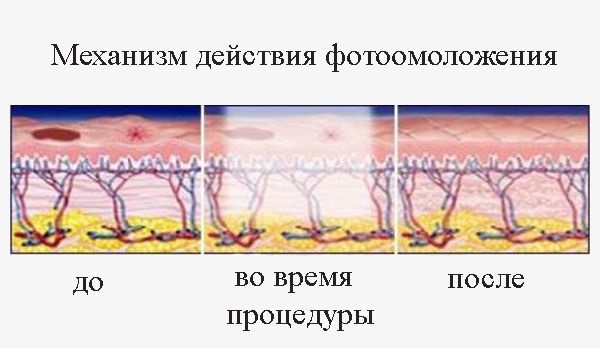 Trẻ hóa khuôn mặt - nó là gì, ưu và nhược điểm, trước và sau khi chụp ảnh, chỉ định và chống chỉ định