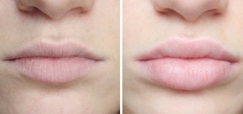 Cách làm to môi bằng axit hyaluronic, botox, silicone, làm đầy môi, tạo hình môi. Kết quả: ảnh trước và sau, giá cả, đánh giá
