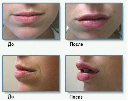 Cách làm to môi bằng axit hyaluronic, botox, silicone, làm đầy môi, tạo hình môi. Kết quả: ảnh trước và sau, giá cả, đánh giá