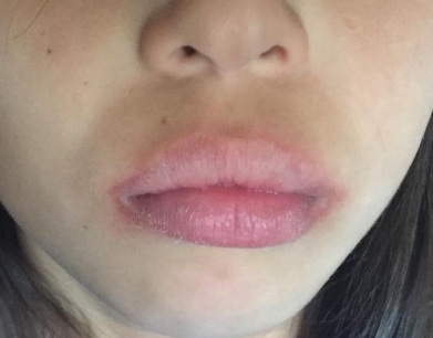 Cách làm to môi bằng axit hyaluronic, botox, silicone, làm đầy môi, tạo hình môi. Kết quả: ảnh trước và sau, giá cả, đánh giá