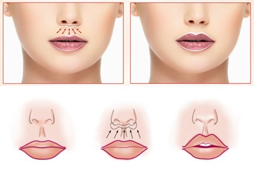 Cách làm to môi bằng axit hyaluronic, botox, silicone, làm đầy môi, tạo hình môi. Kết quả: ảnh trước và sau, giá cả, đánh giá