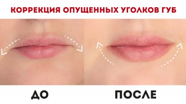 Cách làm to môi bằng axit hyaluronic, botox, silicone, làm đầy môi, tạo hình môi. Kết quả: ảnh trước và sau, giá cả, đánh giá