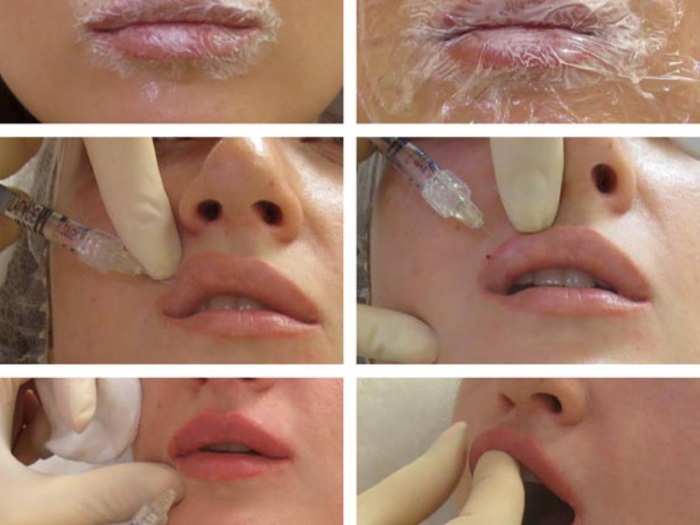 Cách làm to môi bằng axit hyaluronic, botox, silicone, làm đầy môi, tạo hình môi. Kết quả: ảnh trước và sau, giá cả, đánh giá
