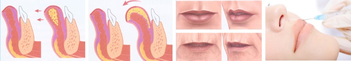 Cách làm to môi bằng axit hyaluronic, botox, silicone, làm đầy môi, tạo hình môi. Kết quả: ảnh trước và sau, giá cả, đánh giá