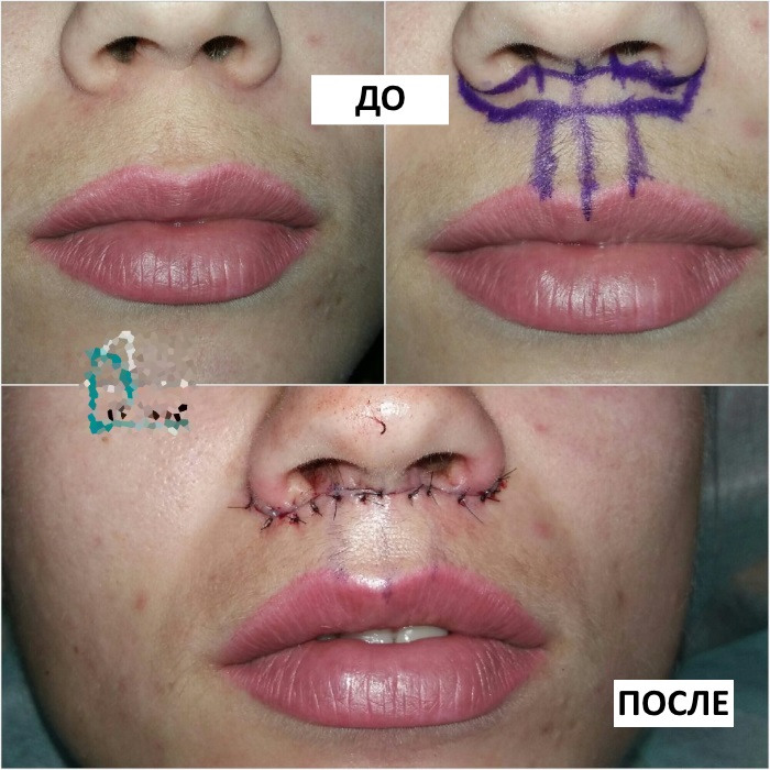 Cách làm to môi bằng axit hyaluronic, botox, silicone, làm đầy môi, tạo hình môi. Kết quả: ảnh trước và sau, giá cả, đánh giá