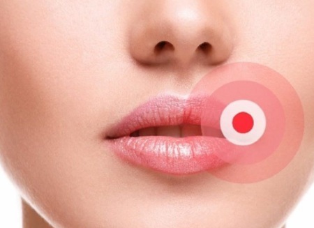 Cách làm to môi bằng axit hyaluronic, botox, silicone, làm đầy môi, tạo hình môi. Kết quả: ảnh trước và sau, giá cả, đánh giá