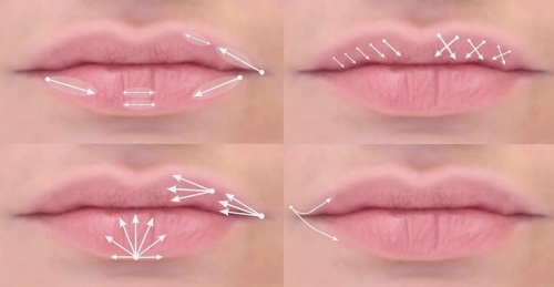 Cách làm to môi bằng axit hyaluronic, botox, silicone, làm đầy môi, tạo hình môi. Kết quả: ảnh trước và sau, giá cả, đánh giá