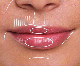 Cách làm to môi bằng axit hyaluronic, botox, silicone, làm đầy môi, tạo hình môi. Kết quả: ảnh trước và sau, giá cả, đánh giá