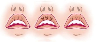 Cách làm to môi bằng axit hyaluronic, botox, silicone, làm đầy môi, tạo hình môi. Kết quả: ảnh trước và sau, giá cả, đánh giá