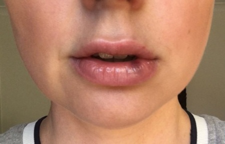 Cách làm to môi bằng axit hyaluronic, botox, silicone, làm đầy môi, tạo hình môi. Kết quả: ảnh trước và sau, giá cả, đánh giá