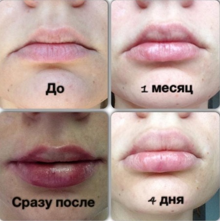 Cách làm to môi bằng axit hyaluronic, botox, silicone, làm đầy môi, tạo hình môi. Kết quả: ảnh trước và sau, giá cả, đánh giá