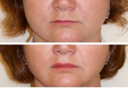 Cách làm to môi bằng axit hyaluronic, botox, silicone, làm đầy môi, tạo hình môi.Kết quả: ảnh trước và sau, giá cả, đánh giá