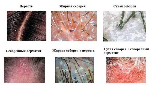 Како излечити краставу перут, суву кожу, себореју содом бикарбоном, бојом, луком, уљем чајевца