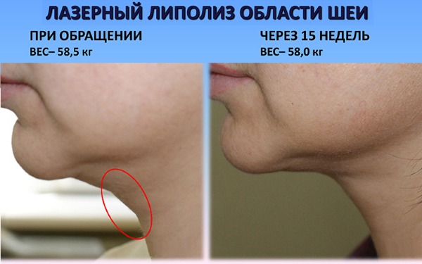 ดูดไขมันคางด้วยเลเซอร์. ภาพถ่ายวิธีการดำเนินการระยะเวลาการฟื้นฟูผลที่ตามมาบทวิจารณ์