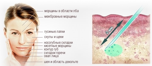 Mesotherapy và biorevitalization: sự khác biệt, lợi ích và tác hại sau khi lột da, chỉ định và chống chỉ định