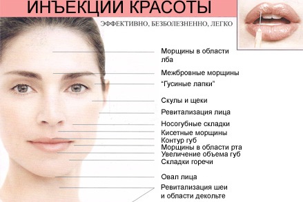 Mesotherapy và biorevitalization: sự khác biệt, lợi ích và tác hại sau khi lột da, chỉ định và chống chỉ định