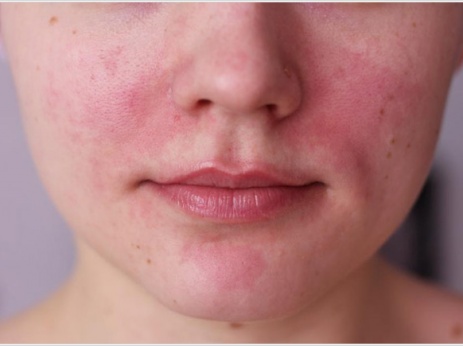 Mesotherapy và biorevitalization: sự khác biệt, lợi ích và tác hại sau khi lột da, chỉ định và chống chỉ định