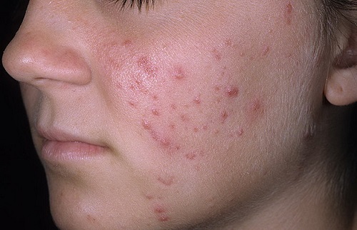 Mesotherapy và biorevitalization: sự khác biệt, lợi ích và tác hại sau khi lột da, chỉ định và chống chỉ định