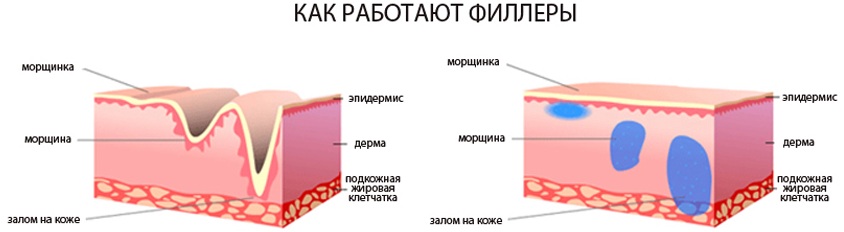 Chất độn trong mũi họng. Nhận xét, hình ảnh trước và sau khi chỉnh sửa. Hiệu quả của thủ thuật, hậu quả và các biến chứng có thể xảy ra