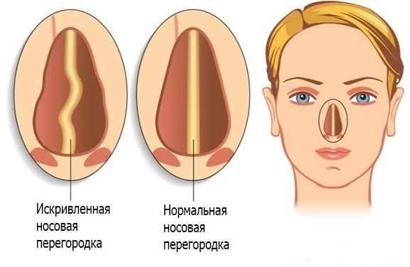 Phẫu thuật vẹo vách ngăn mũi: giai đoạn hậu phẫu, chăm sóc mũi sau chỉnh sửa, phục hồi chức năng. Một bức ảnh