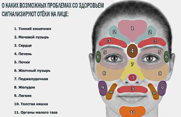 Inchaço sob os olhos pela manhã. Causas e tratamento em mulheres e homens, hematomas matinais, vermelhidão, bolsas nas maçãs do rosto