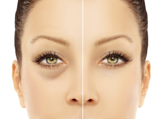 Inchaço sob os olhos pela manhã. Causas e tratamento em mulheres e homens, hematomas matinais, vermelhidão, bolsas nas maçãs do rosto