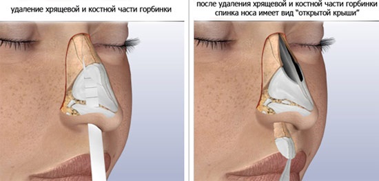 Nâng mũi không phẫu thuật, đóng, mở, tái tạo, tiêm, phục hồi chức năng