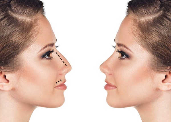 Nâng mũi không phẫu thuật, đóng, mở, tái tạo, tiêm, phục hồi chức năng