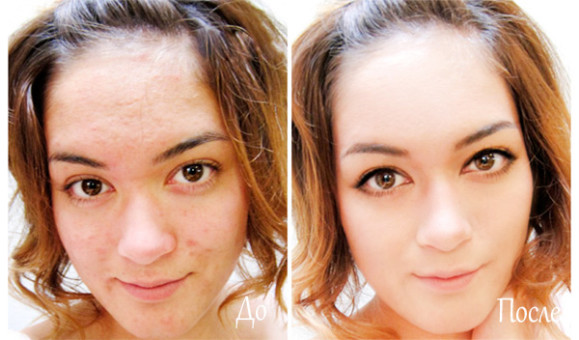 مرهم Solcoseryl. تعليمات للاستخدام في مستحضرات التجميل والسعر والمراجعات