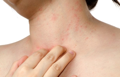 مرهم Solcoseryl. تعليمات للاستخدام في مستحضرات التجميل والسعر والمراجعات
