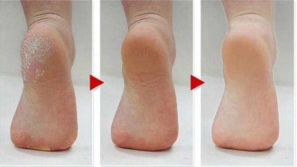 Biện pháp khắc phục cho gót chân nứt nẻ: dân gian với glycerin, amoniac, giấm, trứng, peroxide, lô hội, vitamin E, calendula