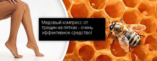 Biện pháp khắc phục cho gót chân nứt nẻ: dân gian với glycerin, amoniac, giấm, trứng, peroxide, lô hội, vitamin E, calendula