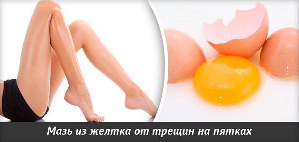 Biện pháp khắc phục cho gót chân nứt nẻ: dân gian với glycerin, amoniac, giấm, trứng, peroxide, lô hội, vitamin E, calendula