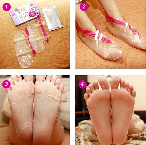 Biện pháp khắc phục cho gót chân nứt nẻ: dân gian với glycerin, amoniac, giấm, trứng, peroxide, lô hội, vitamin E, calendula